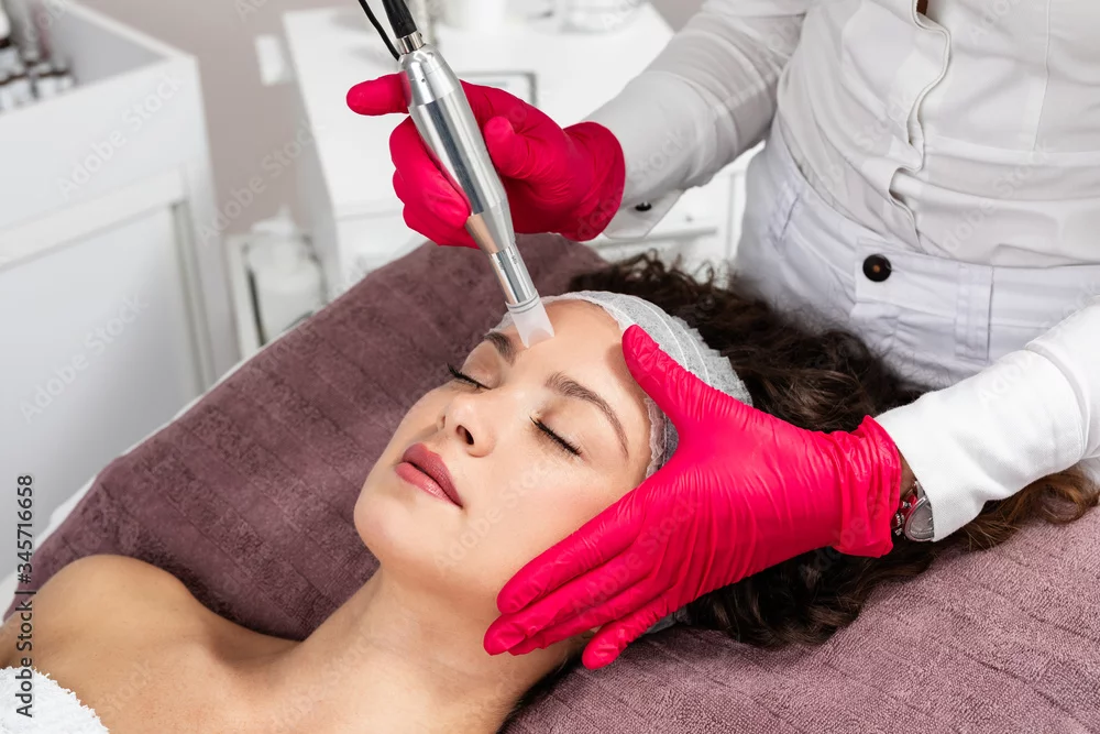 Microneedling treatment